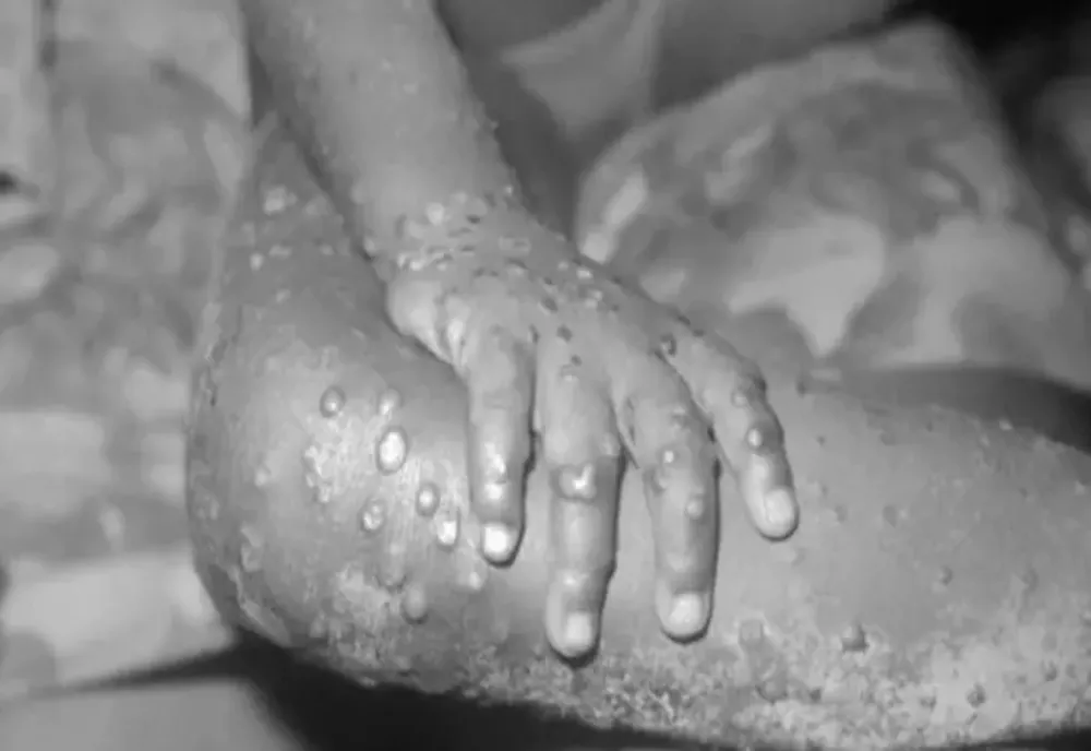 Primul caz de variola maimuţei înregistrat la granița cu România